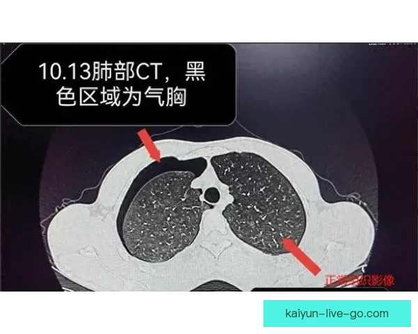 坎宁安气胸恢复顺利 活塞官方公布复查时间和复出计划